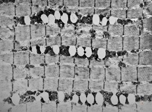 F,46y. | myopathy - steatosis F,46y. | myopathy - steatosis